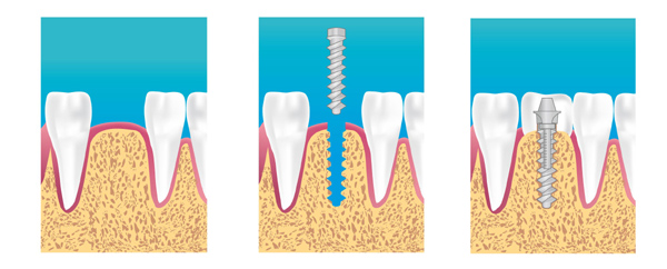 Implants dentaires Champigny-Sur-Marne 94